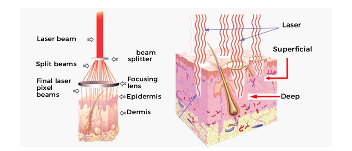 Fractional Co2 Laser Beauty Equipment of Manufactuers