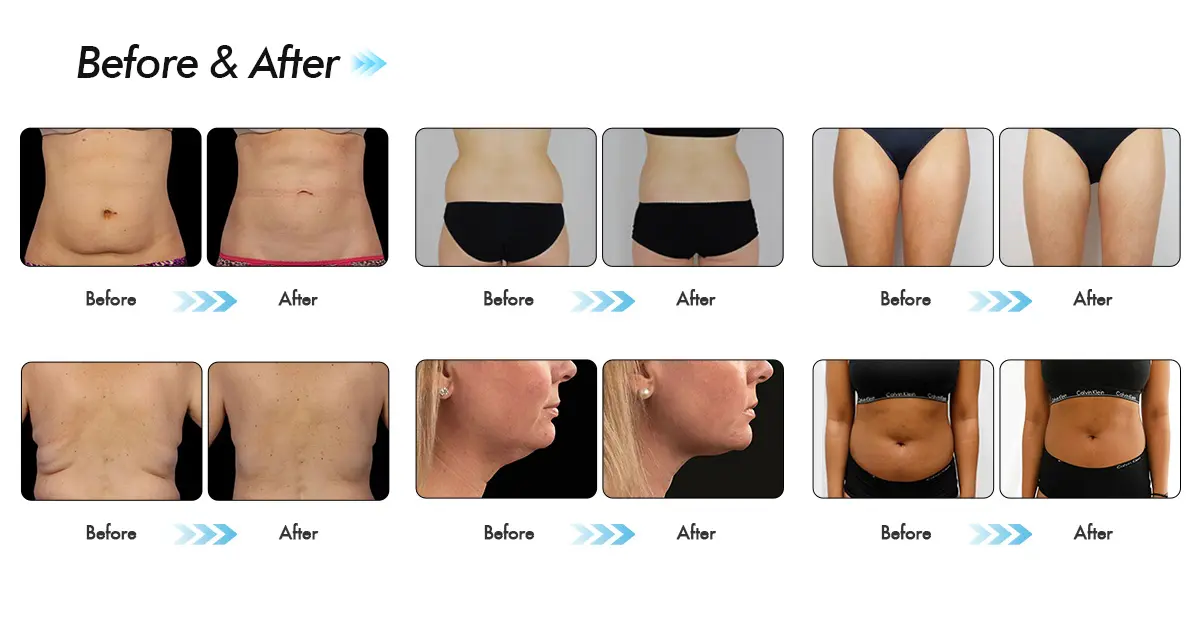 CoolSculpting دستهای بالا: قبل و پس از عکسها: