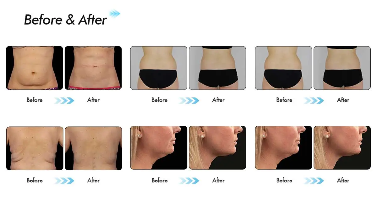 فعالیت CoolSculpting: تغییرات تصویری پس از ۱، ۲ و ۳ هفته