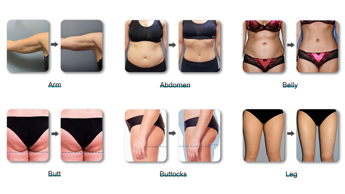 lipolysis-laser-treatment-before-and-after.jpg