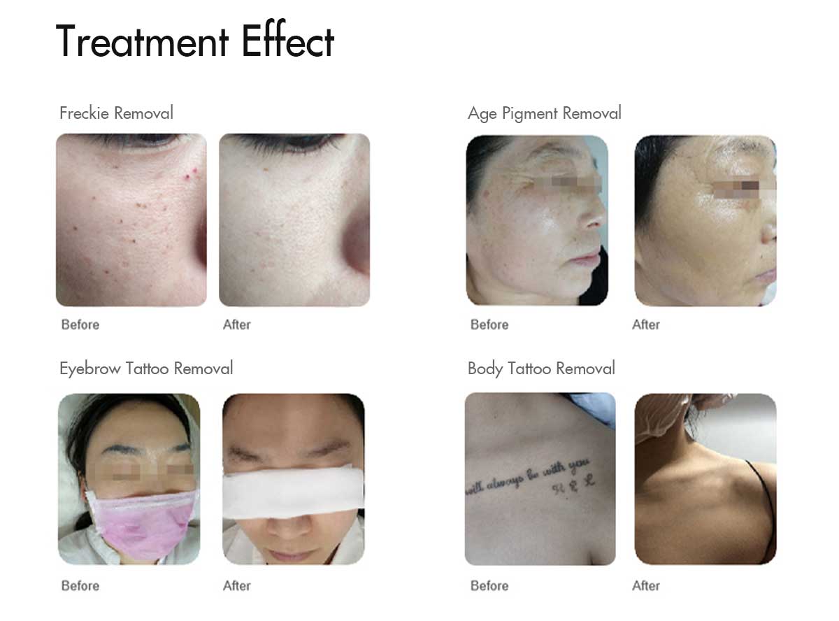 photofacial-treatment-before-and-after.jpg