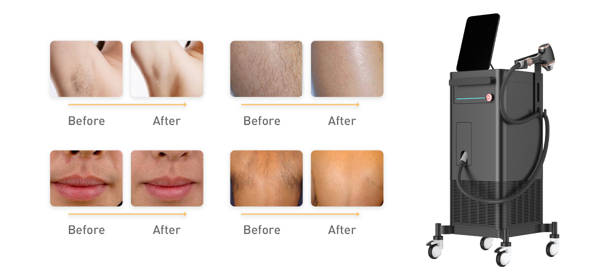 کدام روش حذف موی لیزر بهتر است ؟